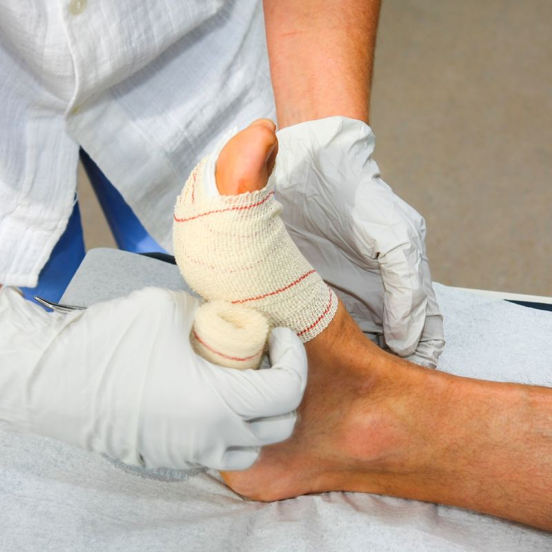 Professional wound care at home by CuttingEdge Wound Experts based in Boca Raton.